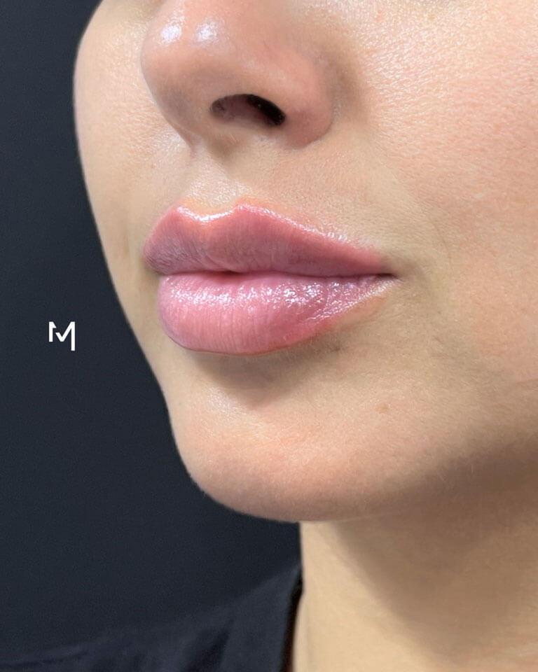 Lip Filler