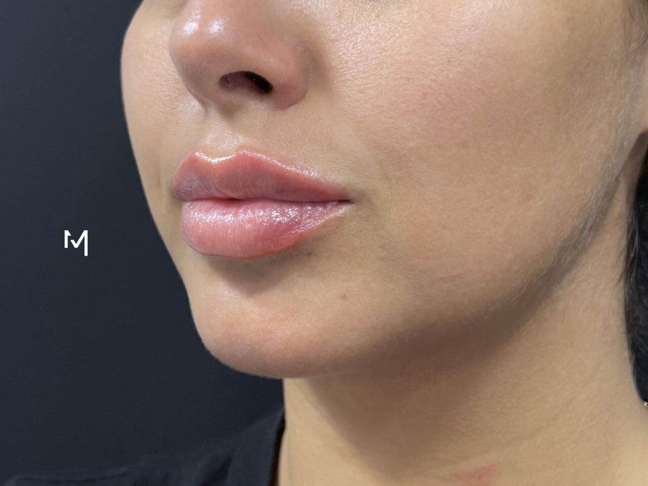 Lip Filler
