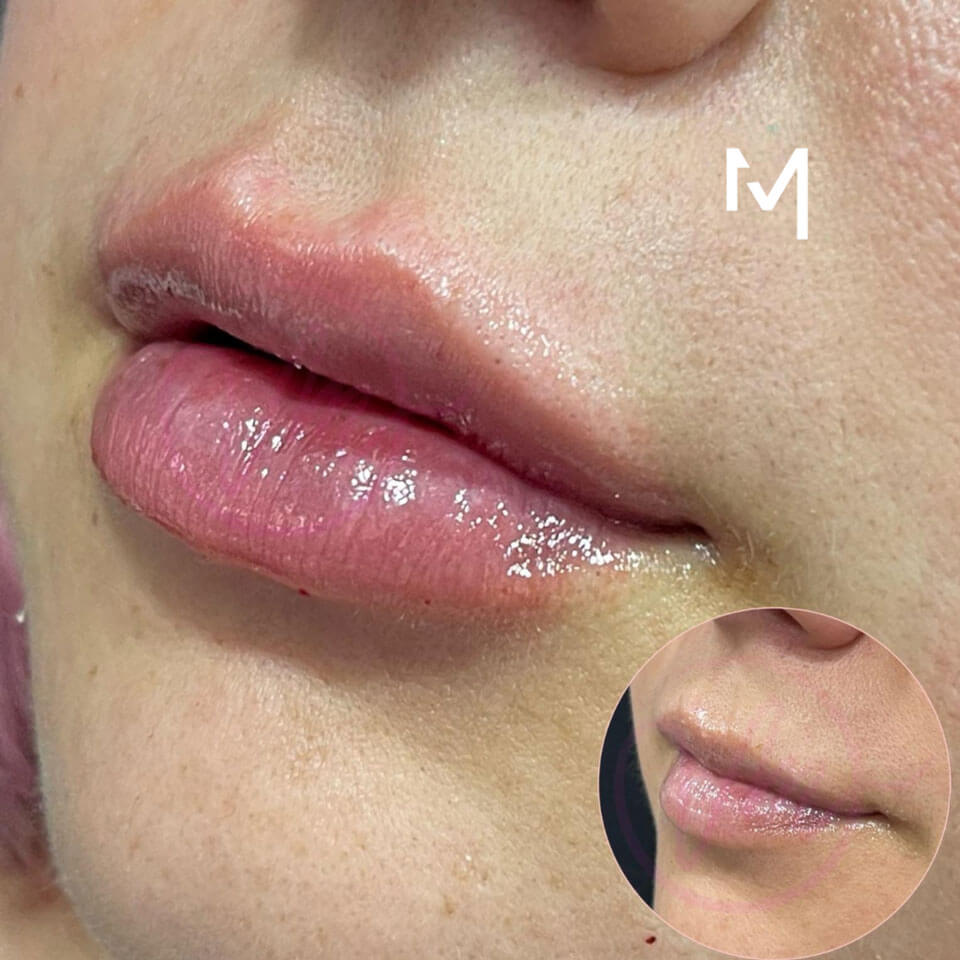 Lip Filler