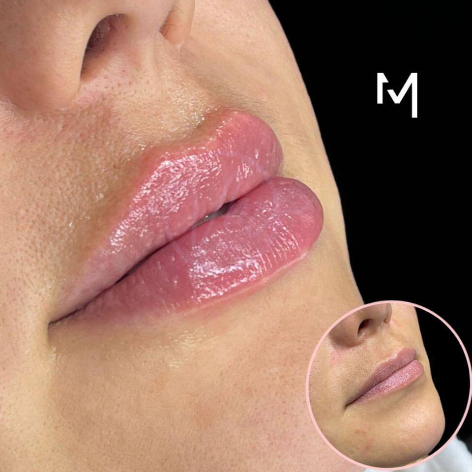 Lip Filler