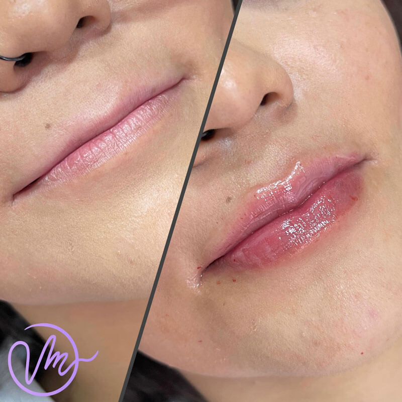 Relleno de Labios