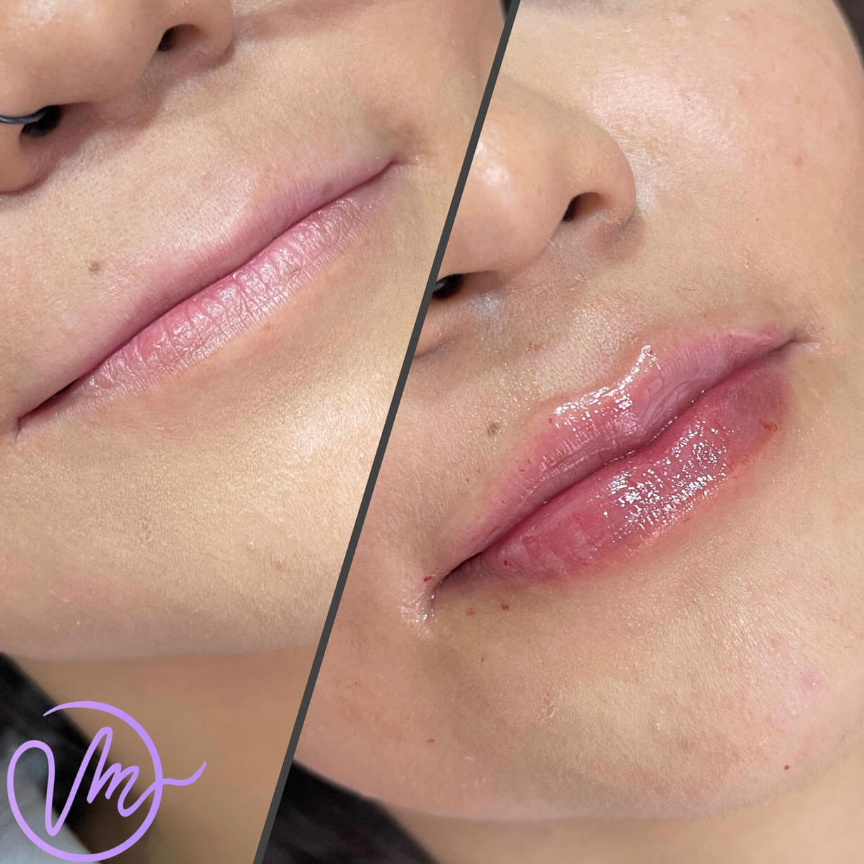 Relleno de Labios