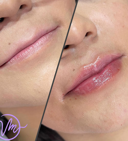 Relleno de Labios