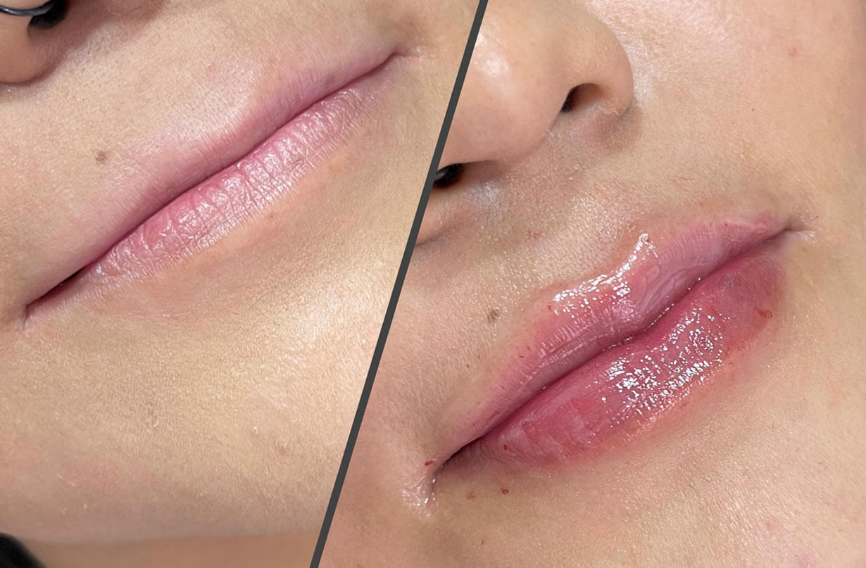 Relleno de Labios