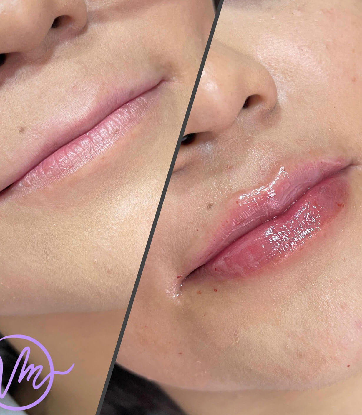 Relleno de Labios