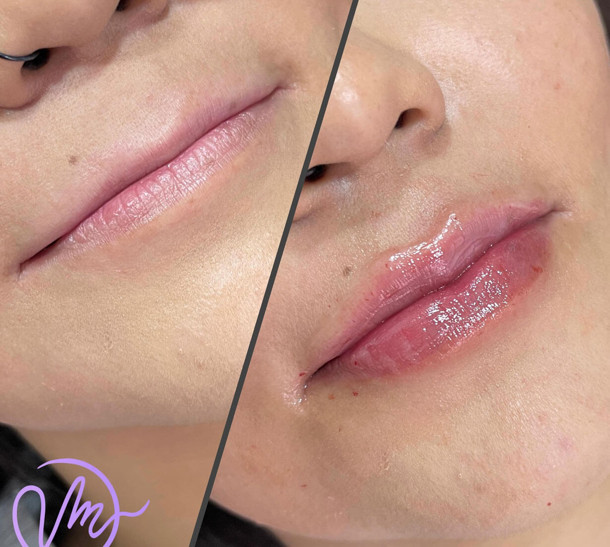 Relleno de Labios