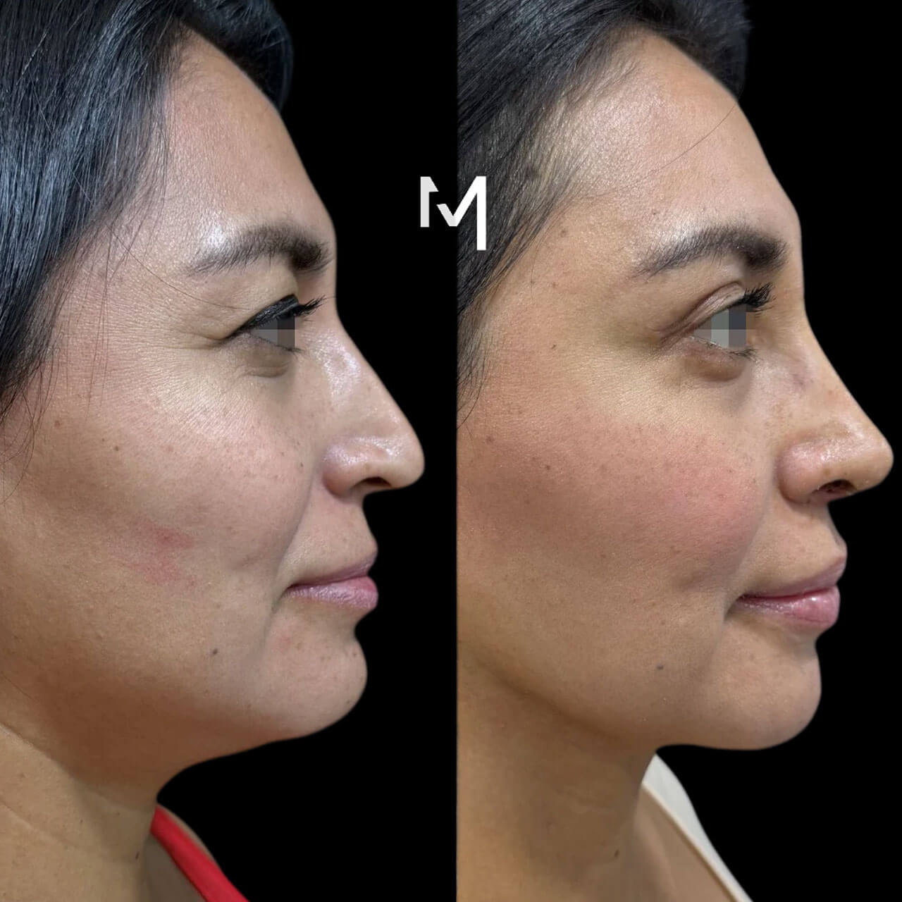 Blepharoplasty, buccal fat removal (bichectomy) & rhinoplasty Blepharoplasty, buccal fat removal (bichectomy) & rhinoplasty